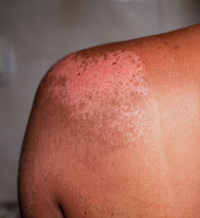 A close-up of a person’s shoulder with visible redness and peeling skin, showing signs of sunburn damage against a blurred neutral background.