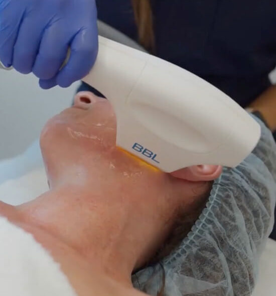 Close-up of a person receiving a BBL (BroadBand Light) facial treatment from a professional wearing gloves.