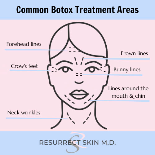 Illustration of common Botox treatment areas on the face and neck, highlighting forehead lines, frown lines, crow’s feet, bunny lines, mouth and chin lines, and neck wrinkles, branded with Resurrect Skin M.D.