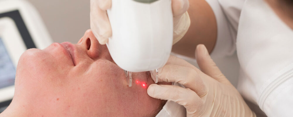 Close-up of a person receiving a facial laser treatment from a professional wearing gloves.